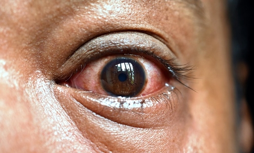 أعراض الفطر الأسود في العين