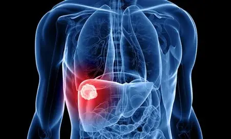 أعراض سرطان الكبد وطرق العلاج
